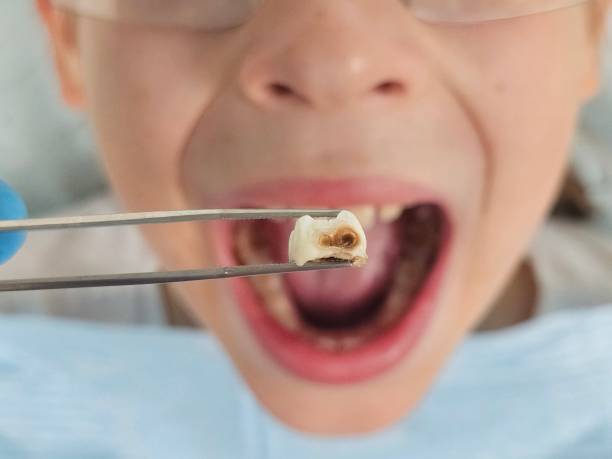 Best Cracked Tooth Emergency Dentist  in Brushy, OK